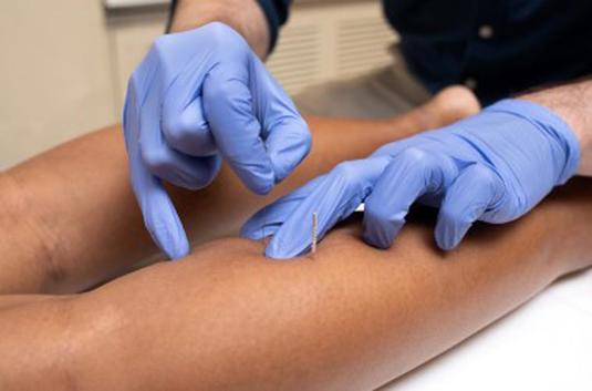 A therapist's hands performing Trigger Point Dry Needling A therapist's hands performing Trigger Point Dry Needling